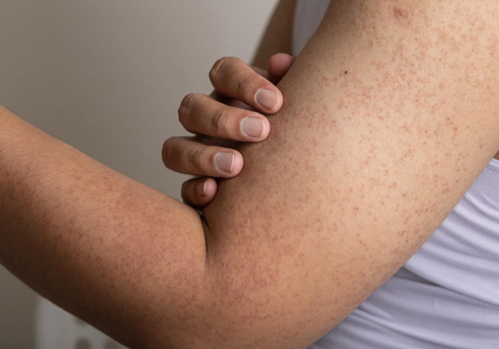 What is chicken skin? We answer your Keratosis Pilaris questions.