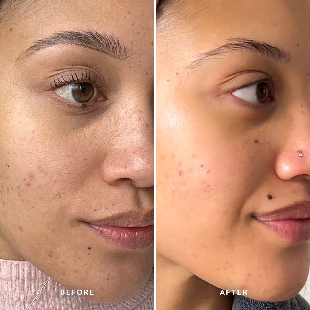 &quot;I was surprised by how well Liquid Gold worked for my skin. Texture has gone down significantly, and my complexion is even, glowing and so soft.&quot;