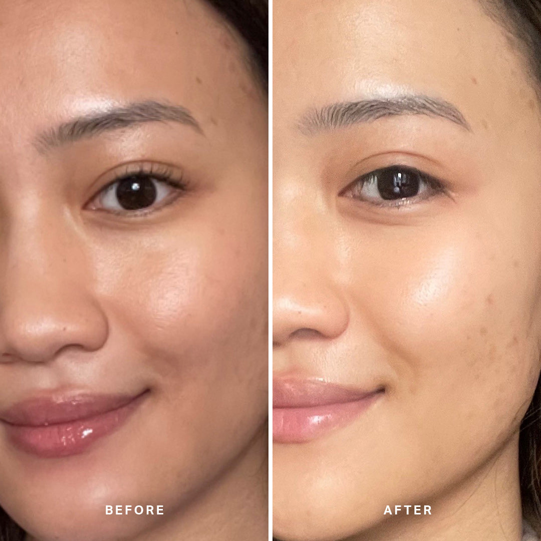 &quot;After 3 weeks, my stubborn acne marks around my cheeks and temples faded. My skin felt very soft and smooth.&quot;